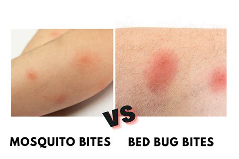 are bed bug bites similar to mosquito bites